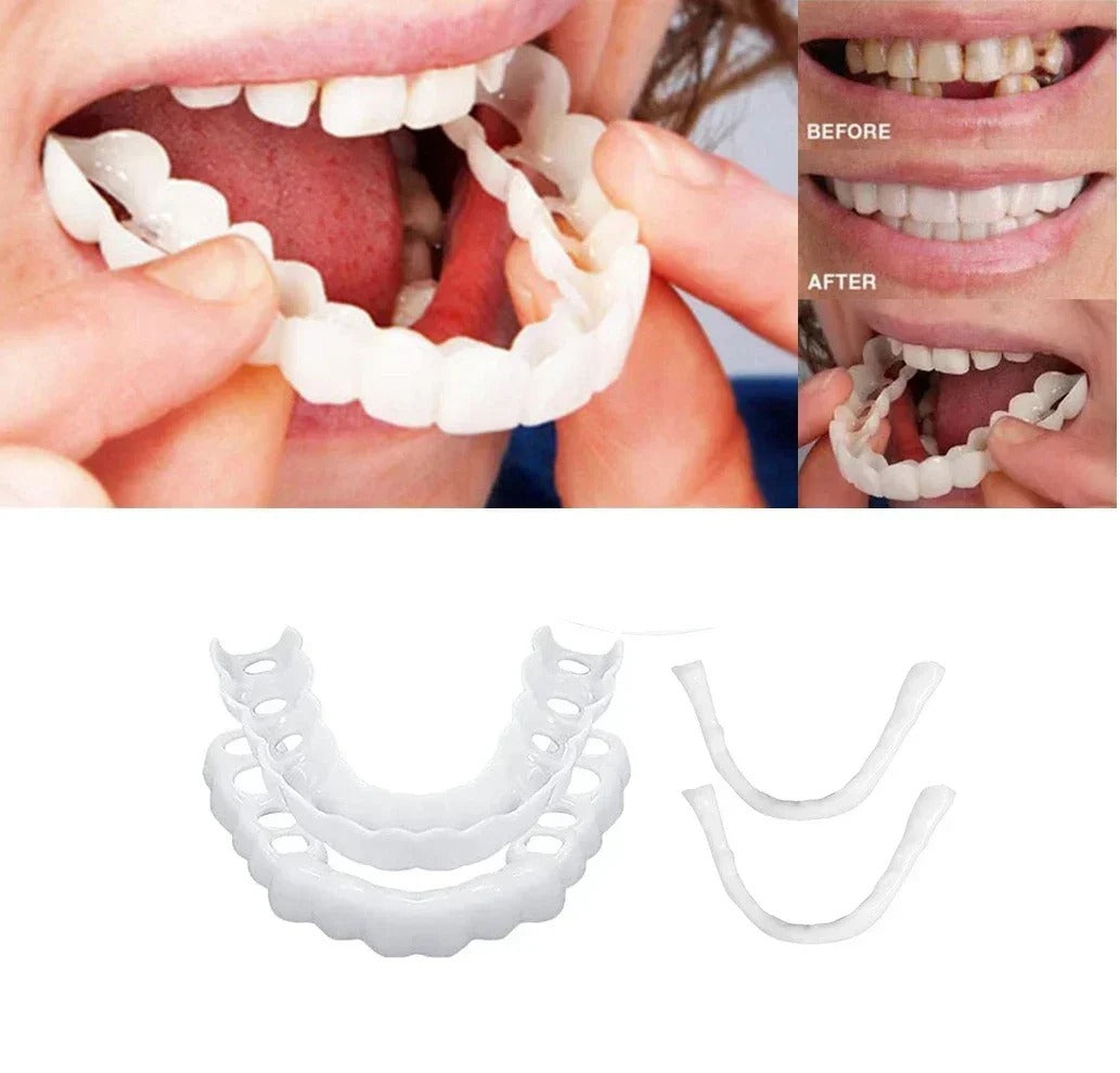 Carillas dentales temporales