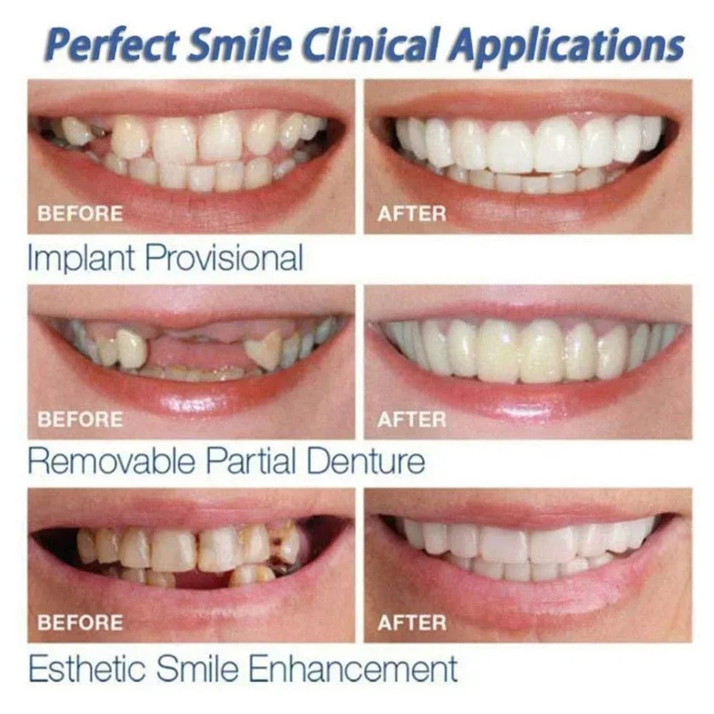 Carillas dentales temporales